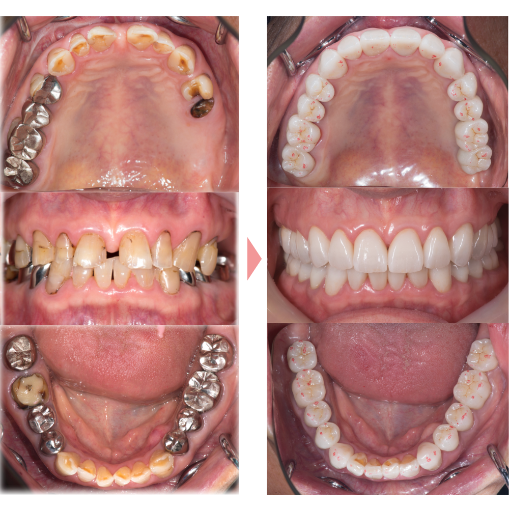 全顎治療（重度虫歯）